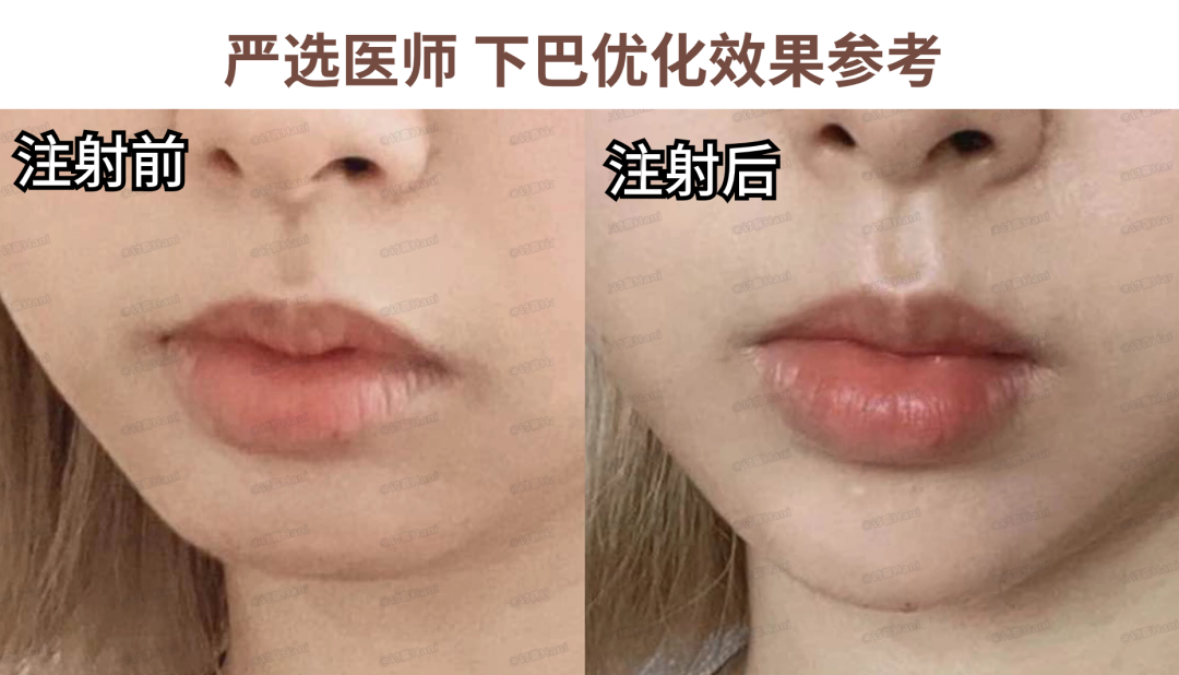婚纱照牙齿不好看会给修嘛_拍婚纱照牙齿太丑怎么办_牙齿不好看婚纱照表情管理