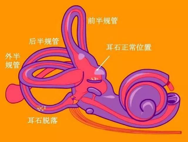 有耳石症能运动吗_耳石症能运动吗_耳石症不能剧烈运动