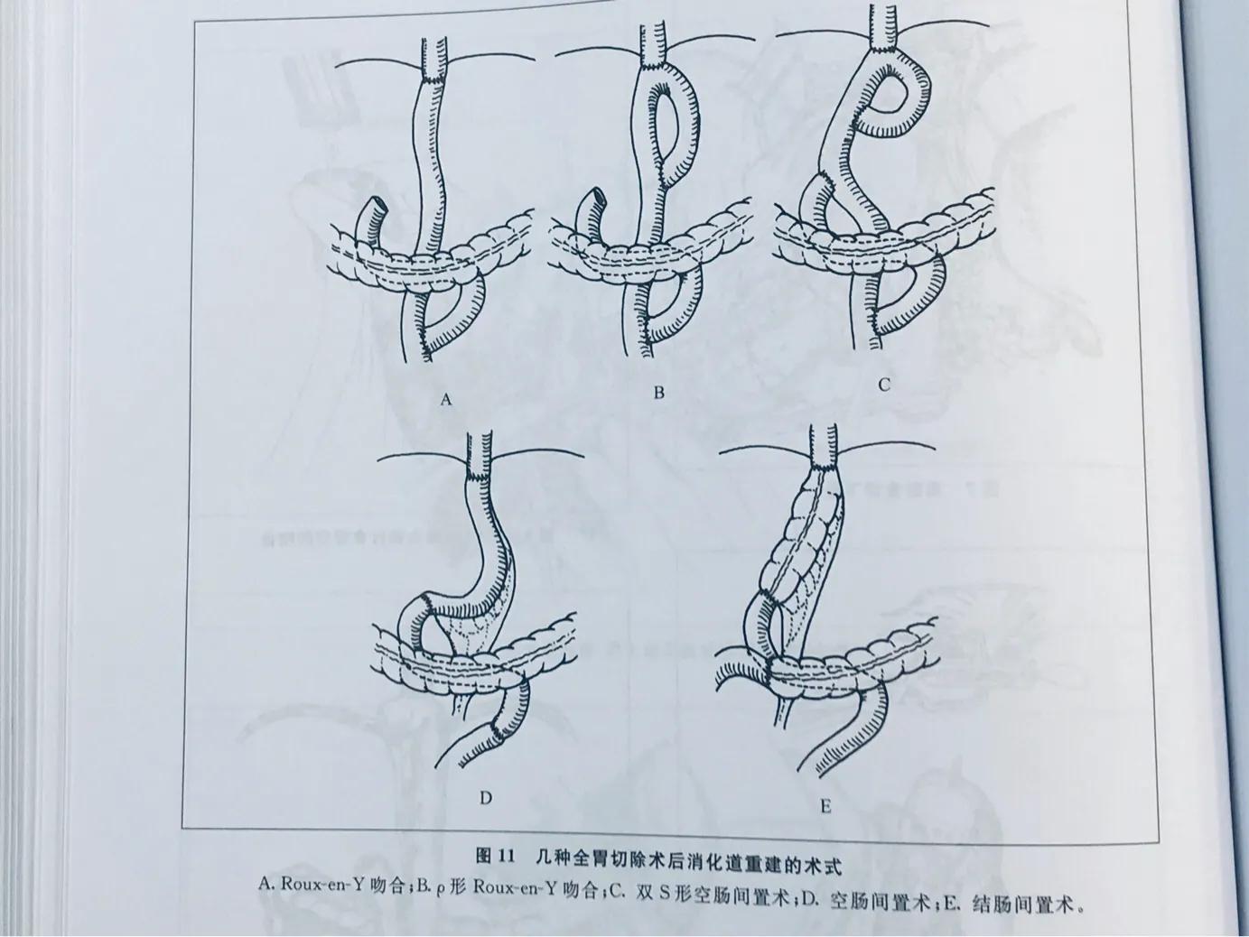 胃癌营养不良发生率_餐营营养患者胃癌能治愈吗_嗯胃癌患者营营养餐