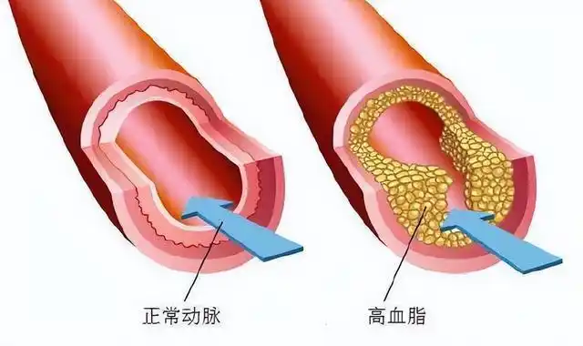 脑卒中病人有氧运动_脑卒中患者给予氧疗_脑卒中氧疗