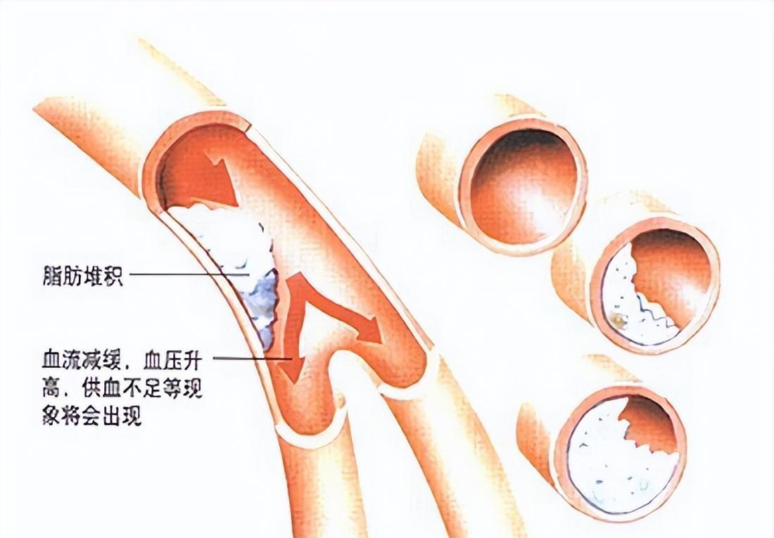 三高会危及生命吗_三高对生活的影响_生活方式会导致三高吗吗